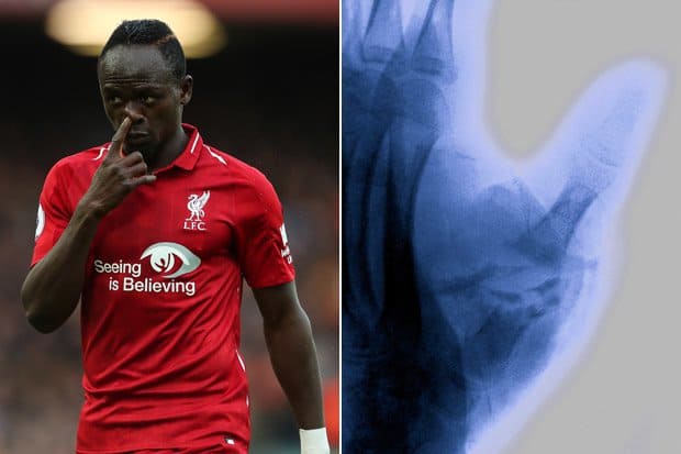 Liverpool - Blessure au pouce : 3 mois d'arrêt pour Sadio Mané ? - wiwsport Liverpool - Blessure au pouce : 3 mois d'arrêt pour Sadio Mané ? - wiwsport