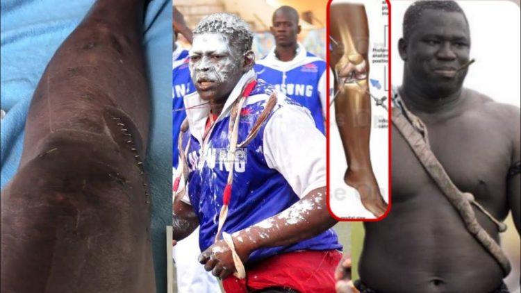 Vidéo- Opération du genou: Ali Ndiaye interpelle les lutteurs, parle du cas de Yekini et conseille Lac Rose - wiwsport